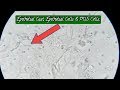 Epithelial Cells In Stool Microscopy