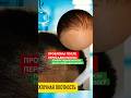 Разочарование после имплантации: где обещанная густота? #пересадкаволос #красавчик #valyn #волосы