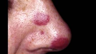 Kaposi's Sarcoma - Usually in AIDS patients with HHV-8