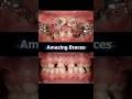 Amazing Braces: Fix extremely wrong teeth. #braces #orthodontist #orthodontics #teeth #dentist
