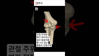 마디사랑병원의 팔꿈치 관절구축 치료 #팔꿈치관절구축 #팔꿈치통증 #shorts