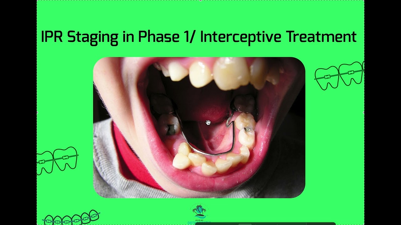 IPR Staging in Interceptive Ortho YouTube