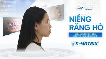 Phép Màu "Hô Biến" Răng Hô Trở Nên Đều Đẹp Bằng Công Nghệ X-Matrix