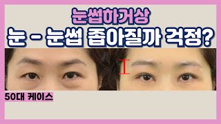 중년 눈썹하거상 수술 전 반드시 알아야 할 핵심