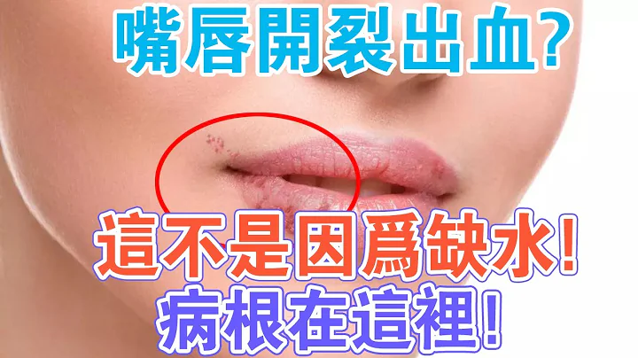 你是不是在為嘴唇乾裂而煩惱？嘴唇乾裂，不是因為缺水，病根在這裏！ - 天天要聞
