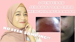 PENYEBAB JERAWAT PASIR DAN  CARA MENGATASINYA !! - Durasi: 16.38. 