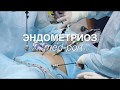 Что такое эндометриоз? Просто о сложном. www.med-port.ru