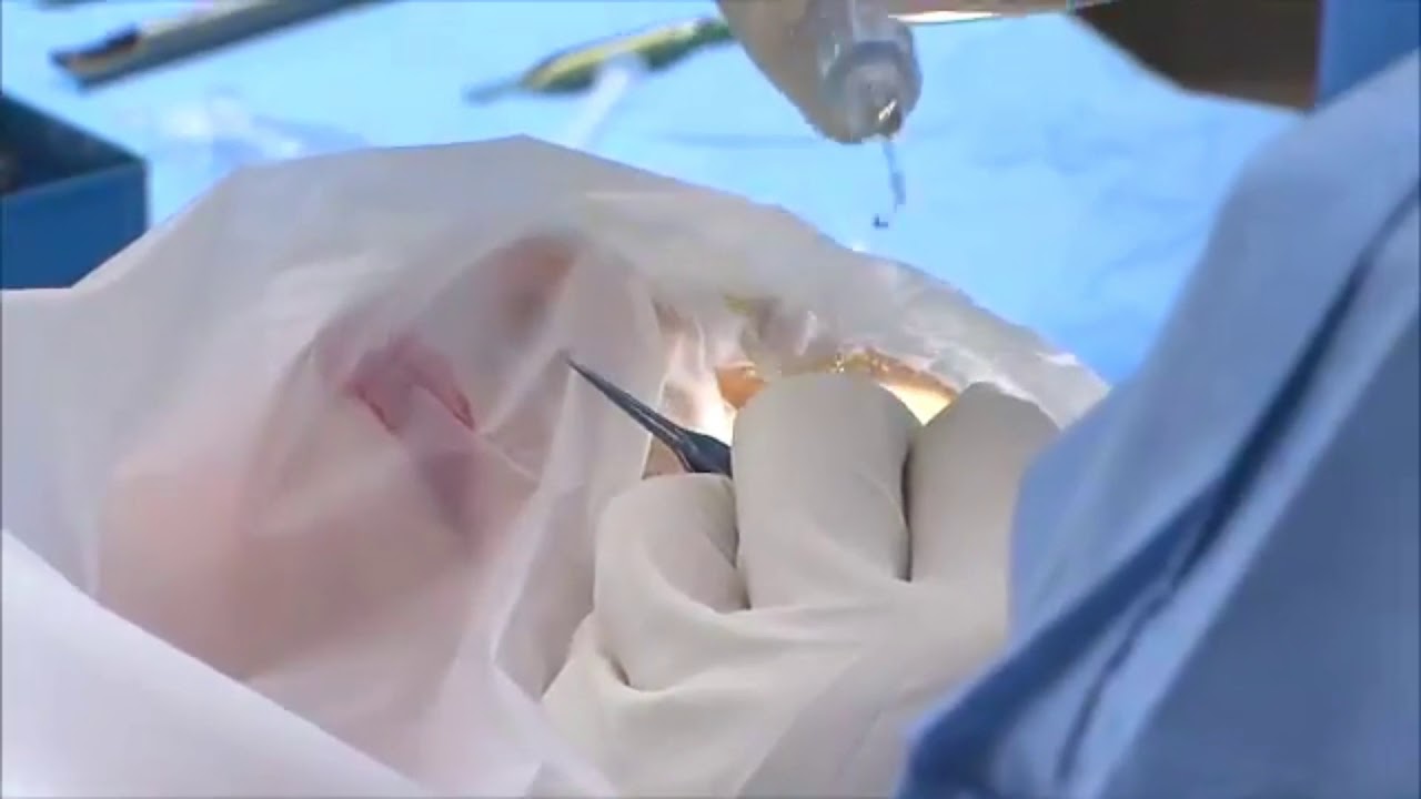 Cataract Surgery Live YouTube