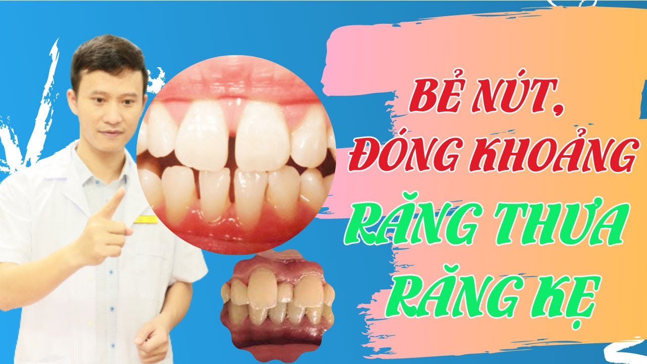 Kỹ Thuật Bẻ Nút Đóng Khoảng Răng Cửa Thưa, Răng Kẹ| Học Chỉnh Nha Bẻ ...
