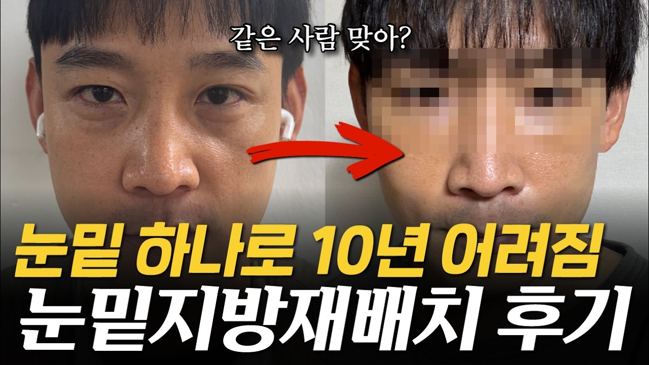 눈밑지방재배치 한달차, 실제로 수술해보니 이렇게 될 줄은 상상도 못했습니다😱