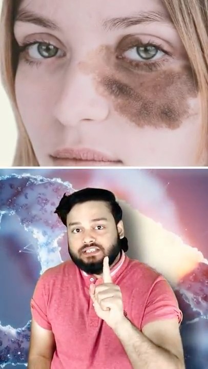 This Girl Has A BIRTHMARK On Her FACE! What is Birthmark #shorts - YouTube