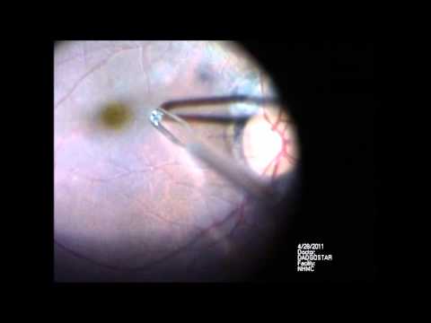 Epiretinal Membrane Removal Epiretinal Membrane Removal