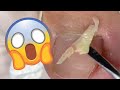 Encravou?! Respira e relaxa! [Renata Werneck Podóloga - Unha Encravada] REMOVE INGROWN NAIL