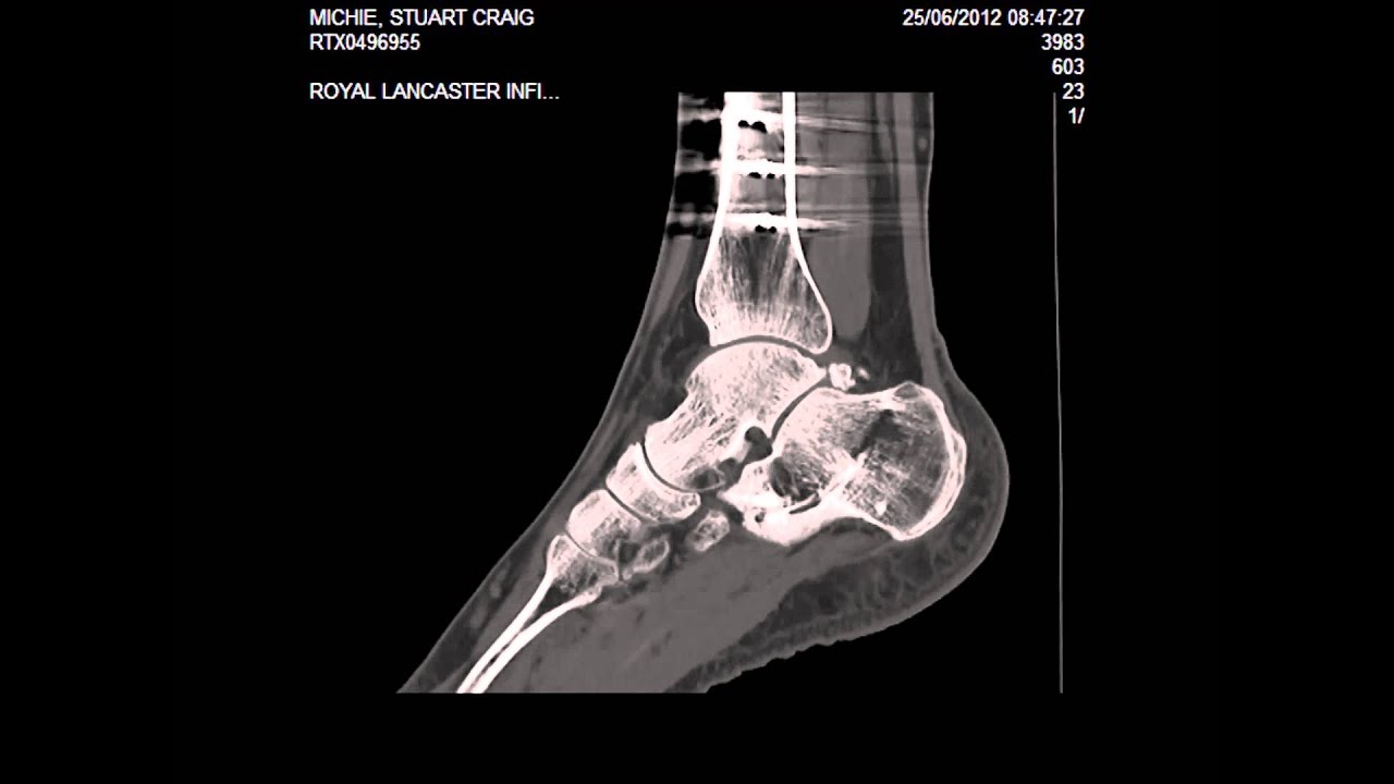 CT Scan Of Ankle YouTube CT Scan Of Ankle YouTube