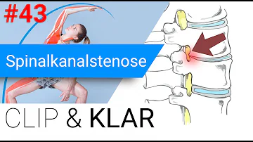 Was sollte man bei Spinalkanalstenose vermeiden?