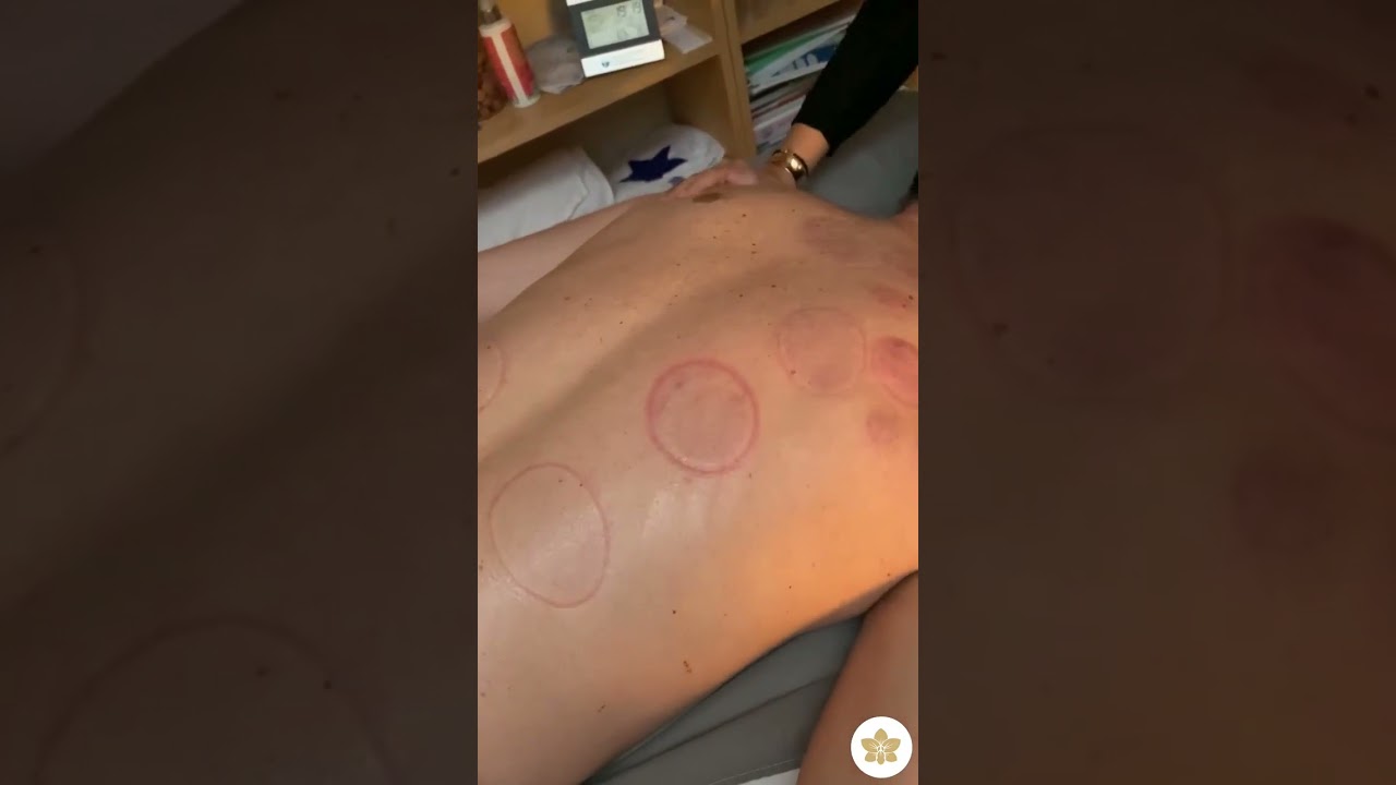 Hijama Beauty - Les marques: explications (1/2)