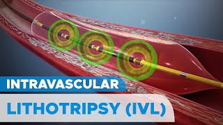 Shockwave Intravascular Lithotripsy (IVL) System for Severely Calcified Coronary Artery Plaques screenshot 2