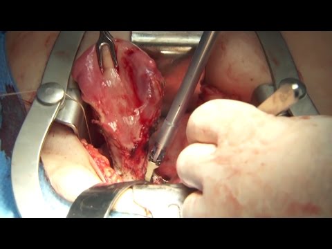 Total Abdominal Hysterectomy Surgery - THUNDERBEAT - Olympus Surgical - Dr. Francois Blaudeau