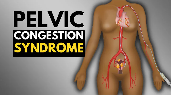 What Is Pelvic Congestion Syndrome? - DayDayNews