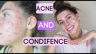 How To Be Confident With Acne || my insecurities, struggles, opening up