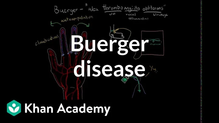 Buerger disease | Circulatory System and Disease |...