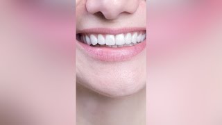 How Long do Veneers Last? | Dental Health