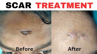 Scar revision surgery| Result after 1 week| Laser scar revision surgery| By  Dr.Pankaj Kumar.