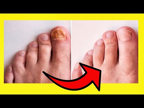 Wideo: 10 Remedios Caseros Para Los Hongos En Las Uñas De Los Pies