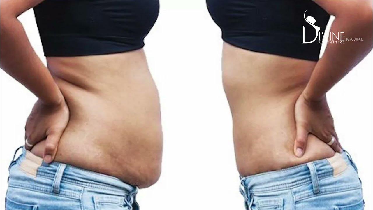 От чего выходит живот. Худой животик. Жир на животе и боках. Животик у девушки. От чего выходит живот.