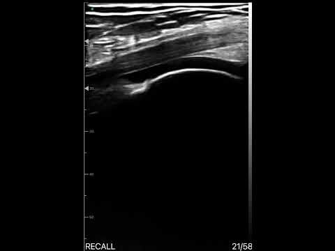 Suprapatellar fat pad and quadriceps tendon ultrasound