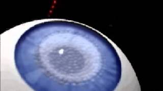 Lasik con láser Femtosegundo Intralase - Femto LDV (100% láser)