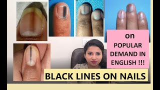 Black lines on nails: what to do?- MBBS MD (MAMC) (SKIN)- ENGLISH 2022