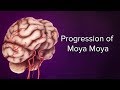 Medical Animation: Progression of Moyamoya | Cincinnati Children's Cerebrovascular Center