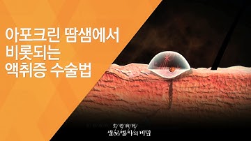 아포크린 땀샘에서 비롯되는 액취증 수술법 - (20120818_424회 방송)_땀과의 전쟁! 여름이 두려운 사람들