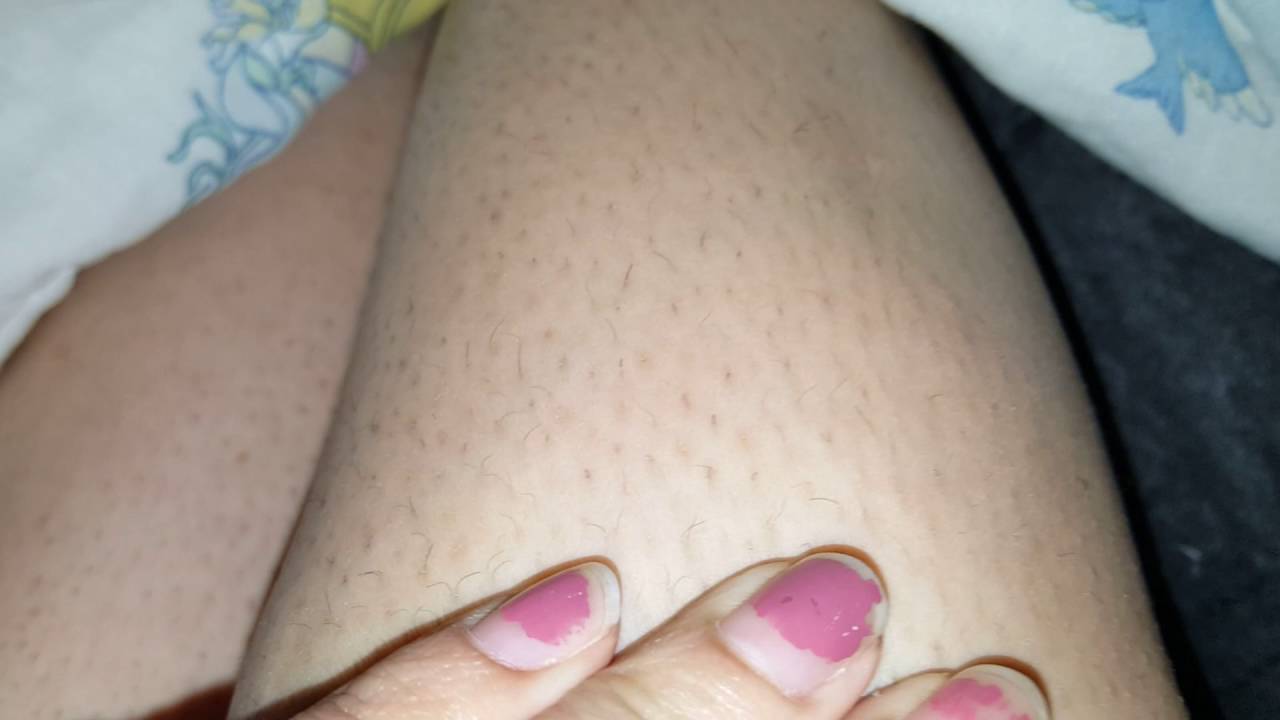 2 Weeks After Epilating With Strawberry Legs YouTube