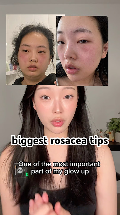 My biggest rosacea tips that helped me heal! #skincare #koreanskincare #kbeauty #rosacea