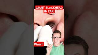 Giant BLACKHEAD REMOVAL FROM EAR - The Biggest I Have Seen #shorts