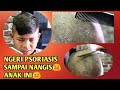 Ngeri  psoriasis pada anak penuh dengan ketombe