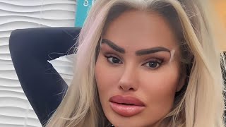 Darcey Silva shows off the results of her facial contouring procedure