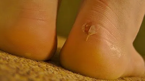 Come curare la disidrosi ai piedi?