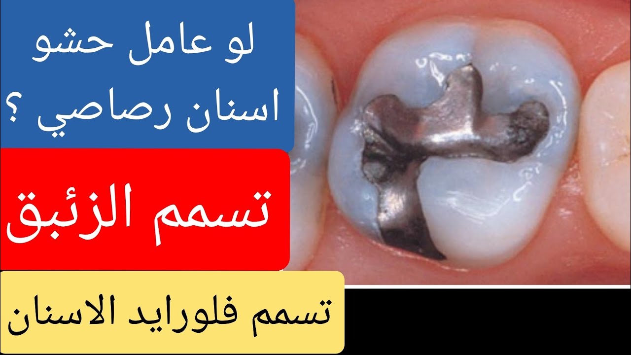 الرد على د. كريم علي فيديو الاسنان ! حشو المعدن و تسمم الفلورايد ؟ لماذا نصحناه بحذف الفيديو ؟ ج2