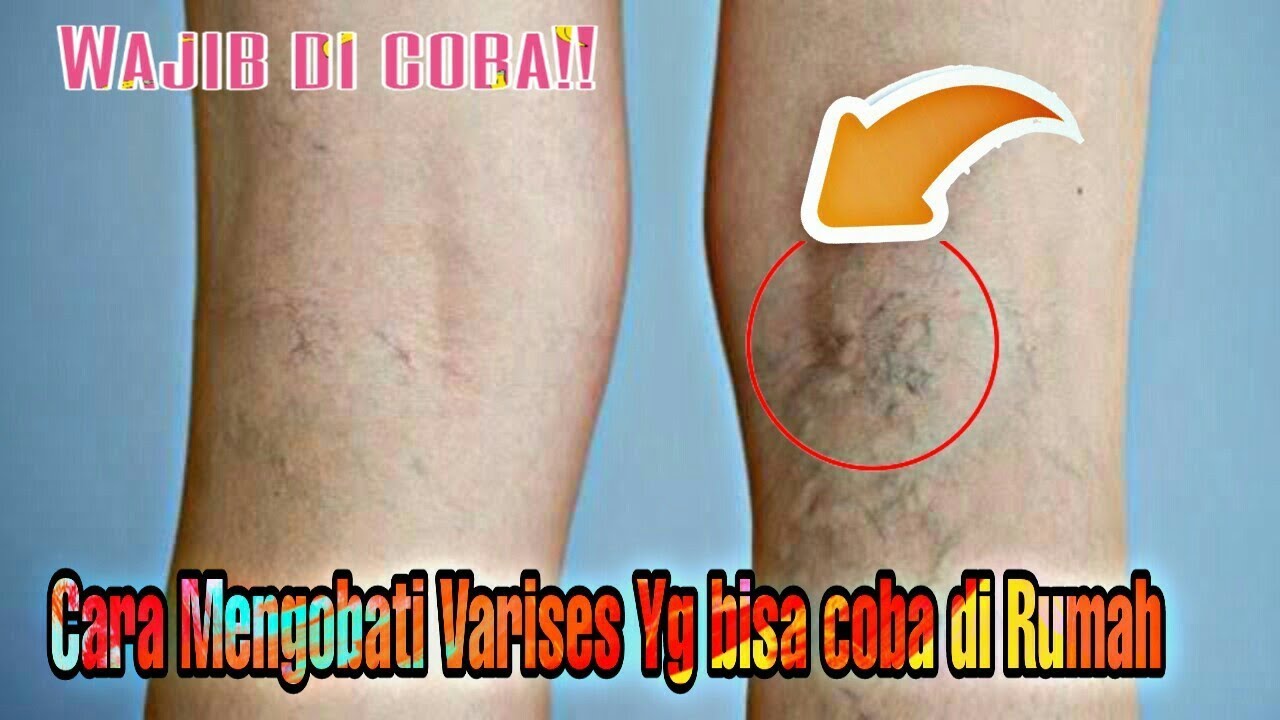 Ingin Ikut Tes jadi Polisi Tapi Varises??Cara Mudah Mengatasi Kaki yg