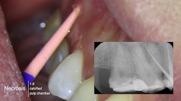 minimally invasive endodontics