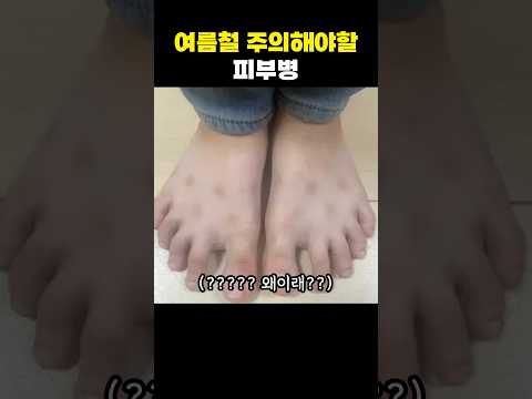 여름철 주의해야할 피부병