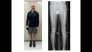 Dr. Rozbruch discusses osteotomy to correct bowleg and medial compartment knee arthritis