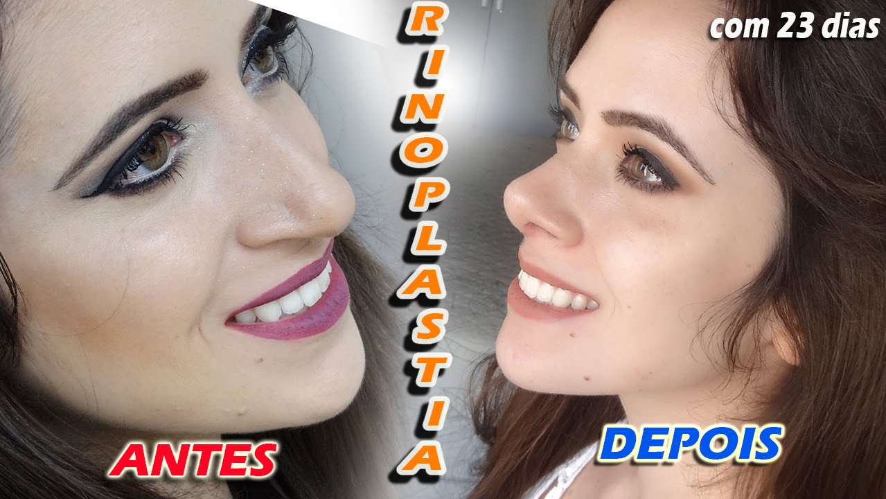 Rinoplastia Parte 2 VLOG P s Operat rio Da Cirurgia Do Nariz YouTube
