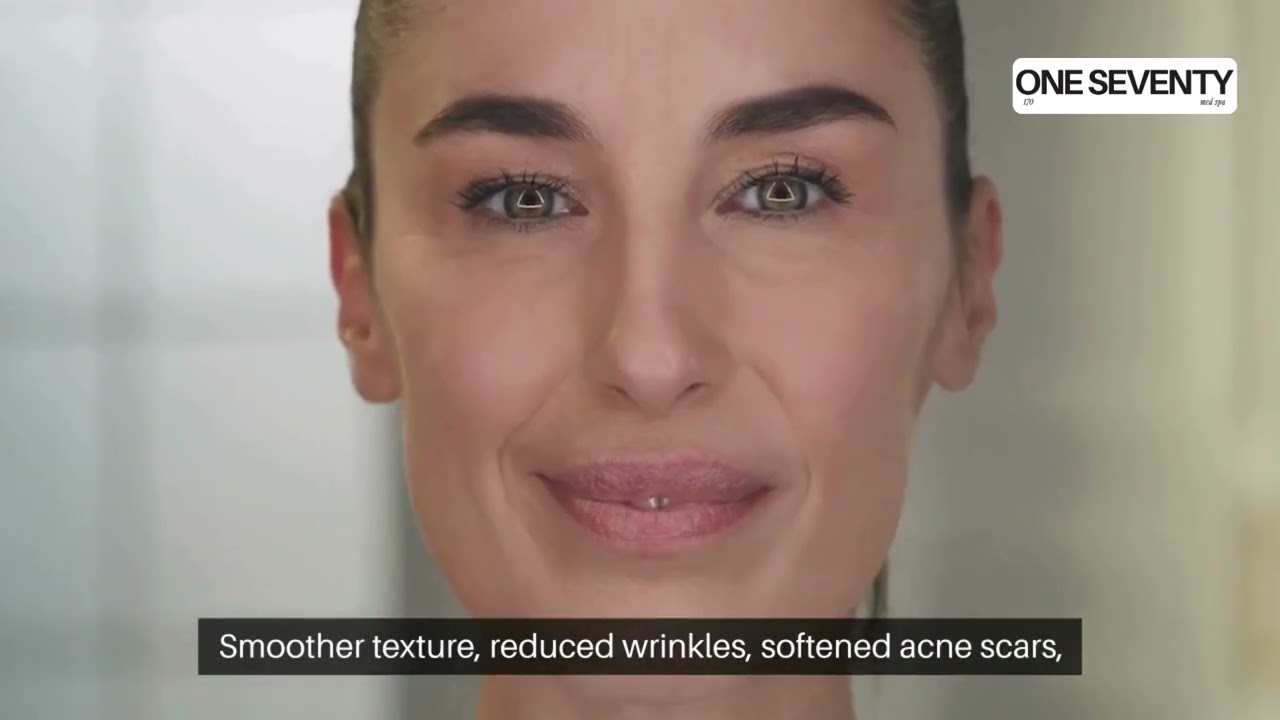 Microneedling in Dallas, TX: Is It Worth It? Benefits Explained