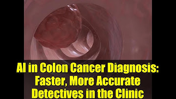 AI in Colon Cancer Diagnosis: Faster, More Accurate Detectives in the Clinic