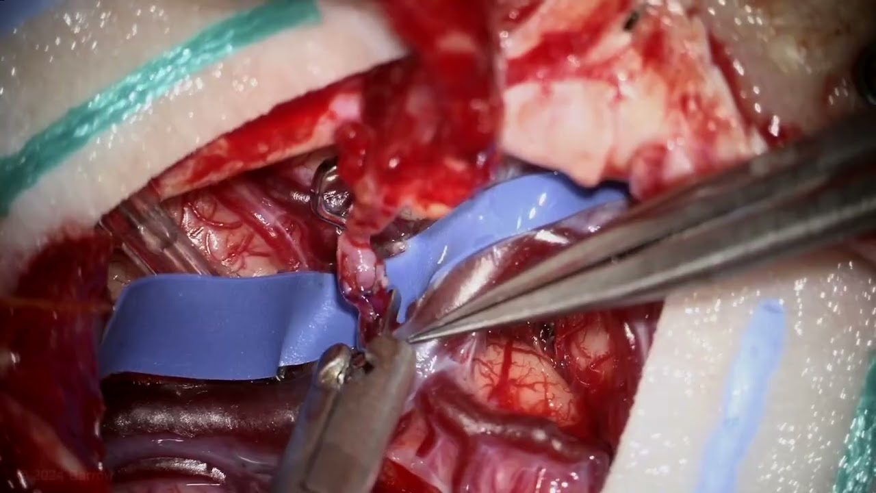 STA to MCA Bypass for Moyamoya Disease Following Two Onlay Bypass Grafts