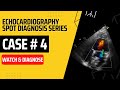 Case 4: Echocardiography Spot Diagnosis Case Series | Watch &amp; Diagnose | Learn Echo Findings | TOACS